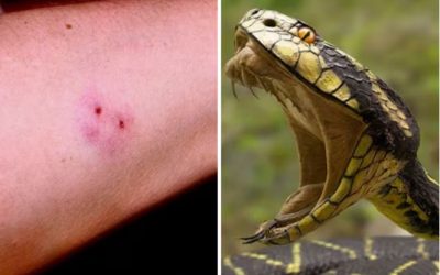 सांप काटने के मामलों में त्रिगुना उछाल, लेकिन जिलों में एंटी वेनम की कमी, मध्य प्रदेश में बढ़ा संकट